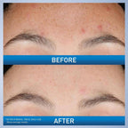 SlimBag CeraVe Resurfacing Retinol Serum with licorice and niacinamide for post-acne marks, brightening, and pore minimization on face