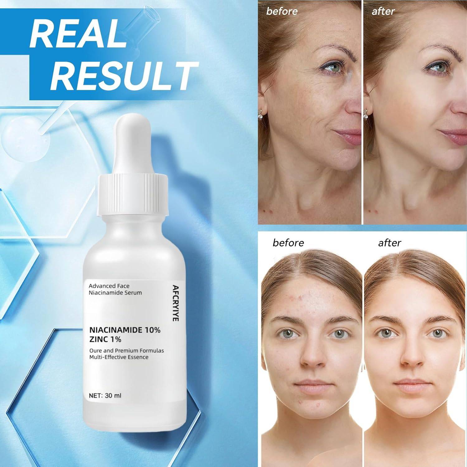 SlimBag Niacinamide 10% + Zinc 1% facial serum bottle showing clear liquid, lightweight, non-greasy formula for acne and pore control.