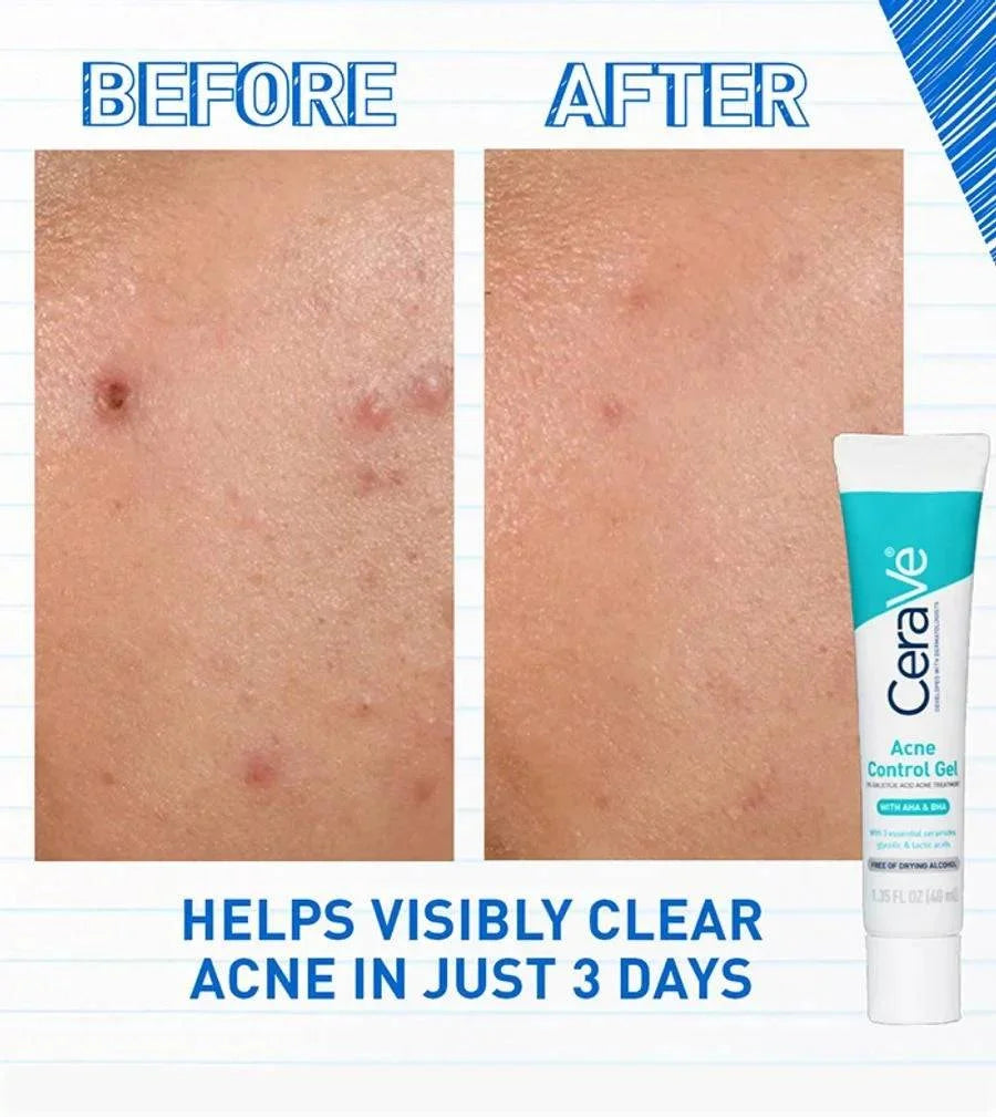 SlimBag CeraVe Acne Control Gel in a tube, showing the skincare product designed to help treat and prevent acne breakouts.