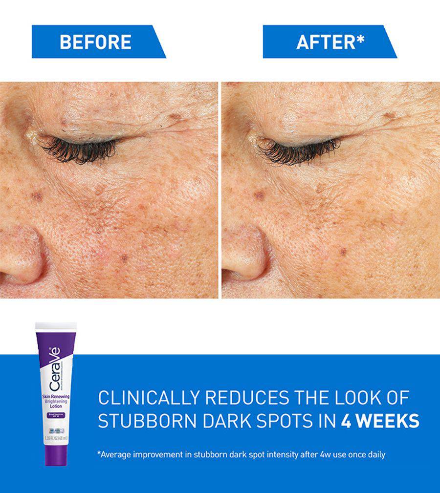 Side-by-side images showing skin before and after using SlimBag Skin Renewing Brightening Lotion with SPF 30 for even skin tone.